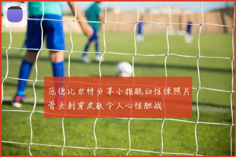 范德比尔特分享小指脱臼惊悚照片骨头刺穿皮肤令人心惊胆战